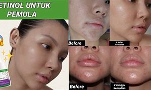 Serum Retinol Sr12 Untuk Apa